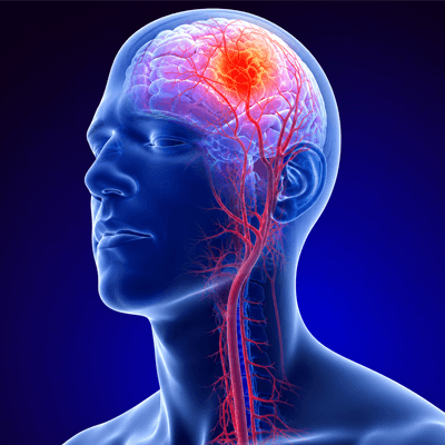 Stroke Management & Acute Stroke Treatment
